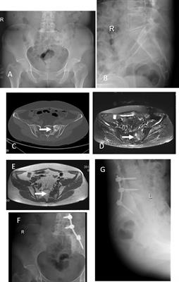 Surgical Treatment of Sacral Metastatic Tumors